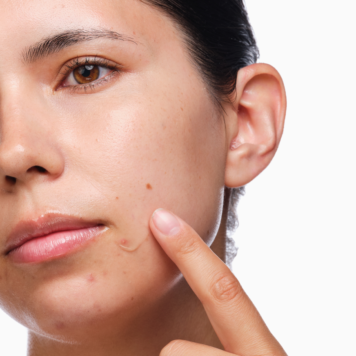 the-acne-set-b9 rdn-the-acne-set-application.png